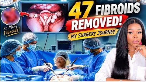 I Had 47 Fibroids Removed… Here’s What Happened | My Surgery Journey